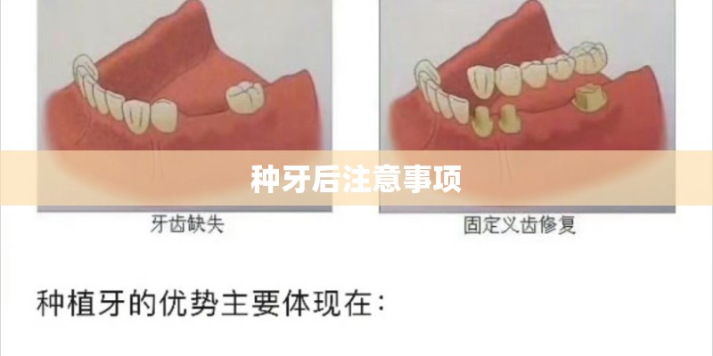 种牙后注意事项 种牙后注意事项